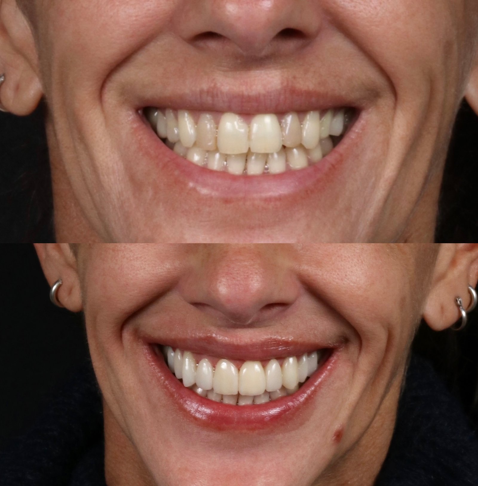 Resultado carillas 2